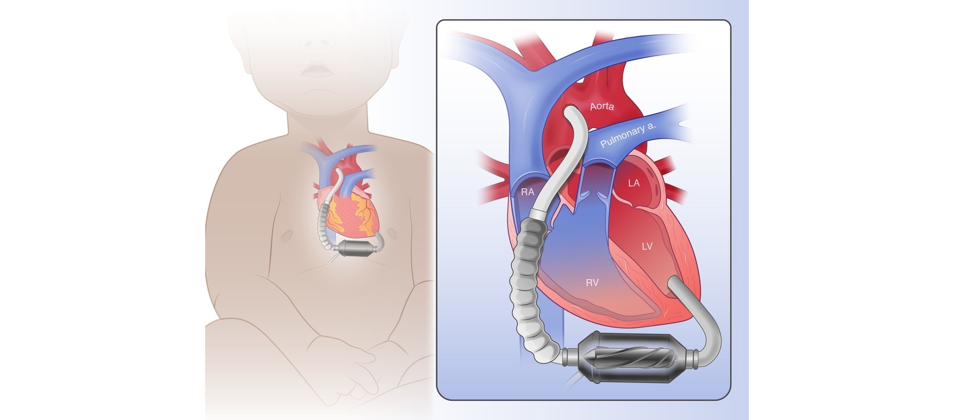 Levitated Implantable Blood Pump Daylab RIT